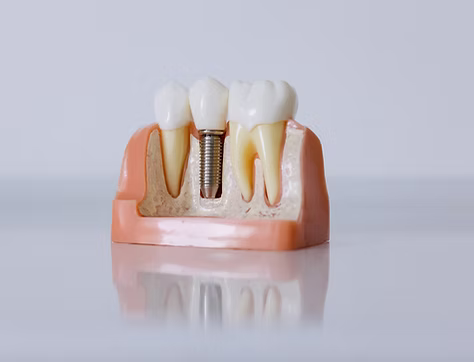 Root Canal Treatment